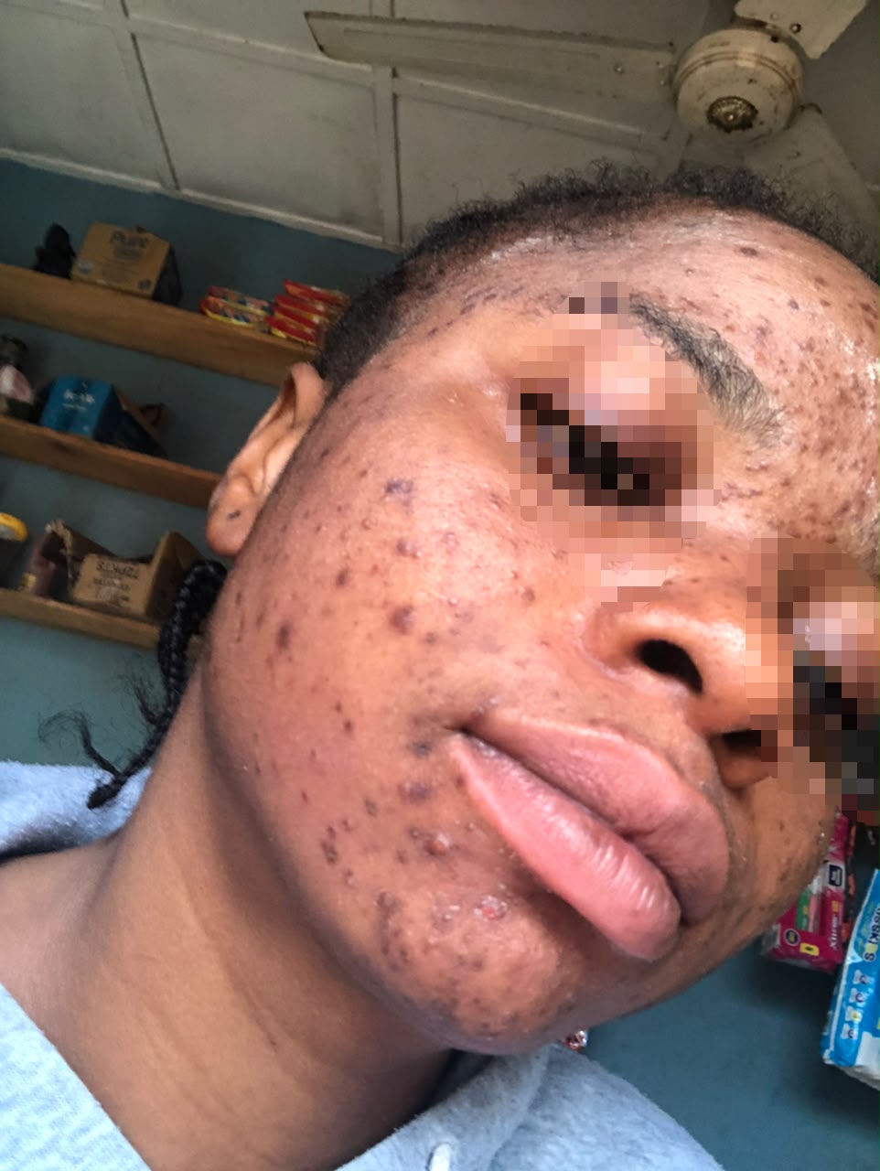 Skin before using Mosidrol