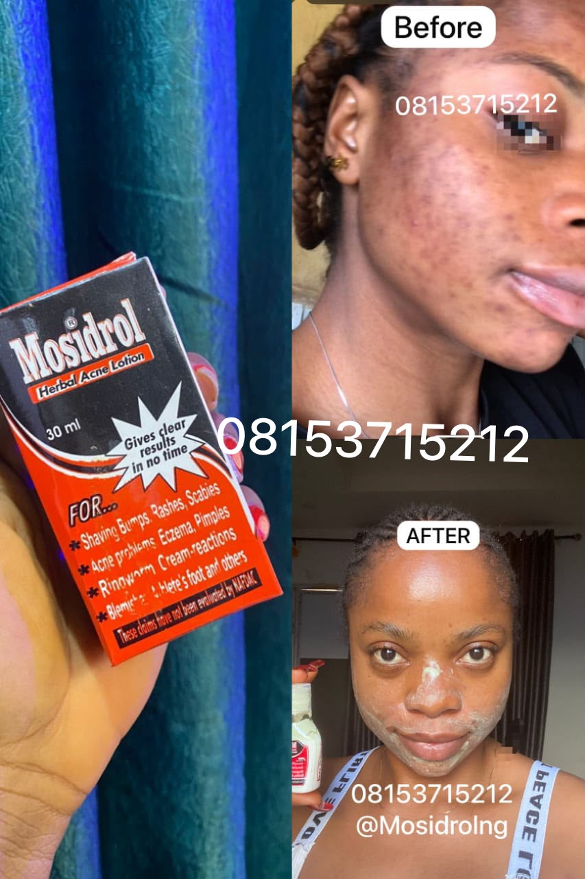 Mosidrol Herbal Acne Lotion bottle