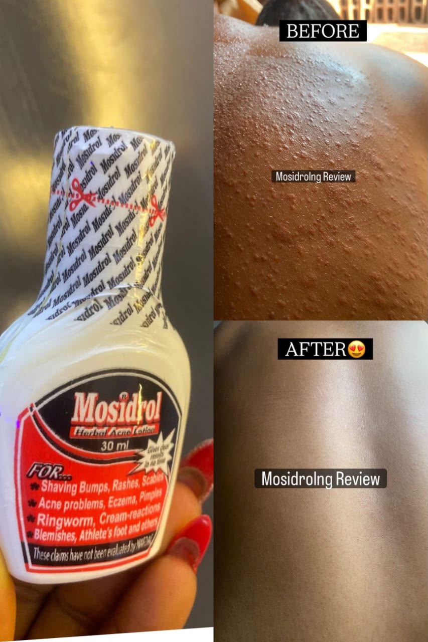 Before and after acne clearance result