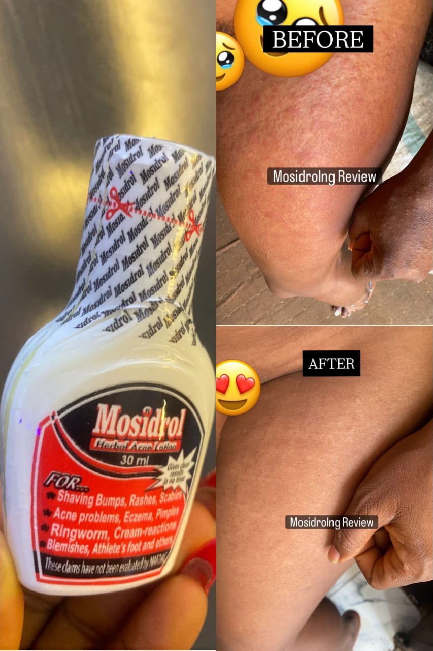 Before and after scalp fungal infection result