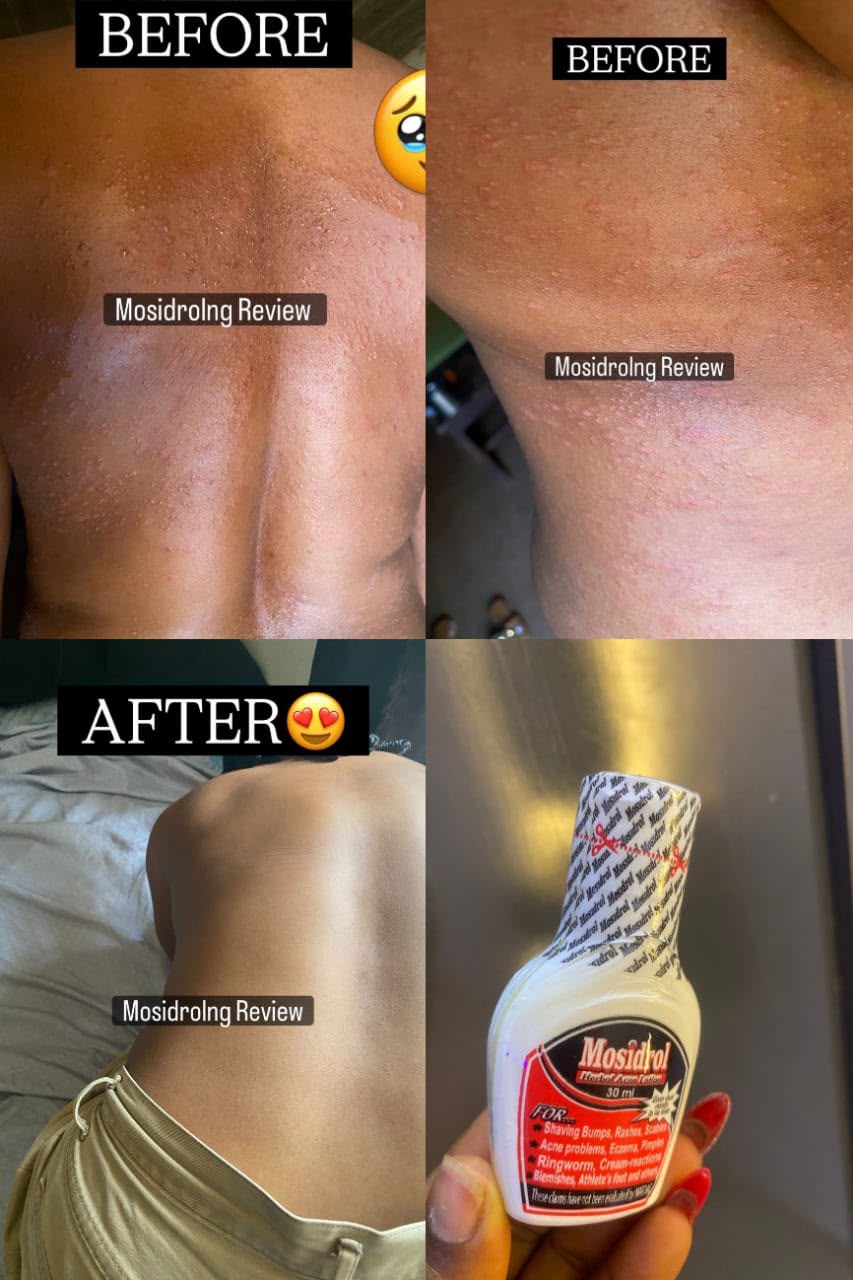 Before and after dark spot and acne result